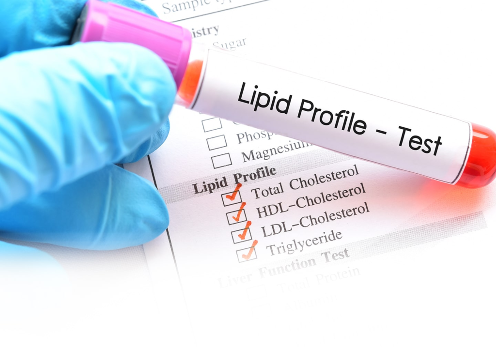 Lipid Profile Test 